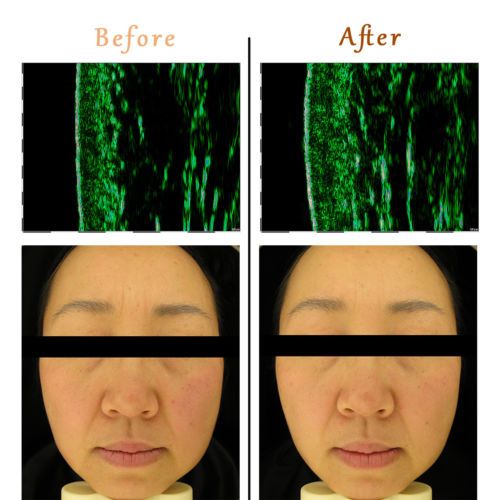 630 NM Red Light Face Mask